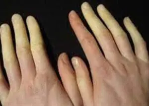 تغير لون اصابع اليد