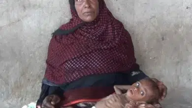 سوء التغذية والامراض يهددان أطفال اليمن